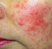 acne-rosacea