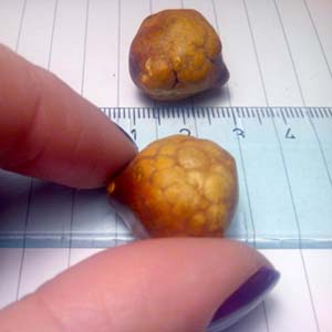 natural remedies for gallstones